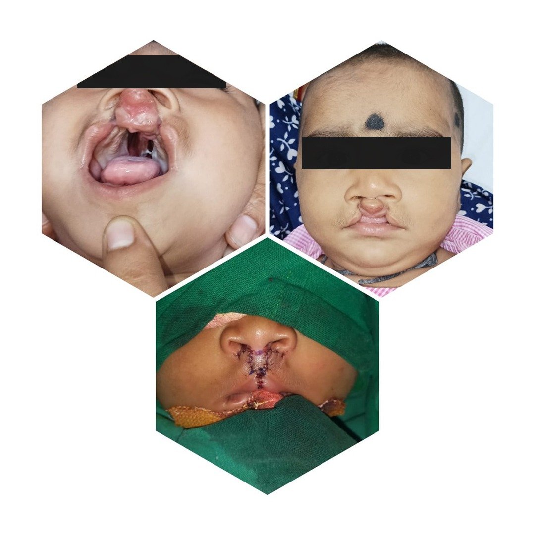 bilateral cleft lip repair